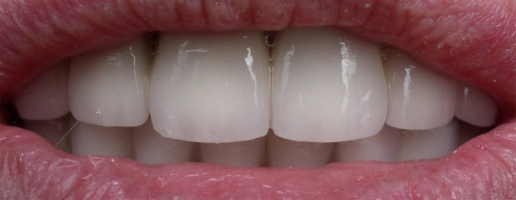 Протезирование полной беззубой челюсти с окклюзионной нагрузкой на имплантатах с следующим протезированием неизменной ортопедической конструкцией